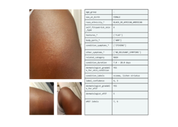 SCIN: A new resource for representative dermatology images